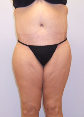 Thigh Lift Before & After Image