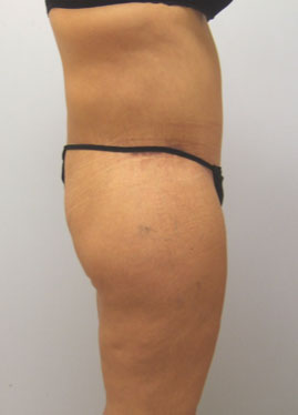 Thigh Lift Before & After Image