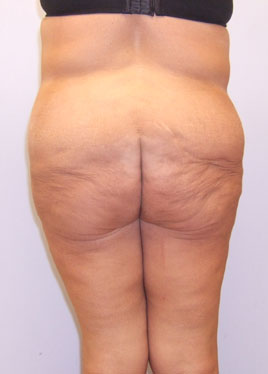 Thigh Lift Before & After Image