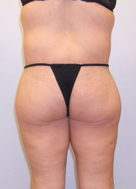 Thigh Lift Before & After Image