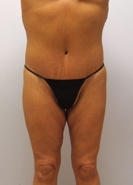 Thigh Lift Before & After Image