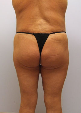 Thigh Lift Before & After Image