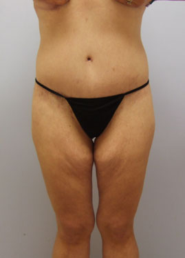 Thigh Lift Before & After Image