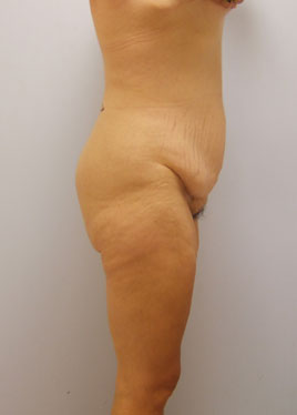 Thigh Lift Before & After Image