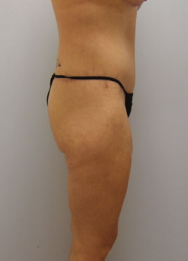 Thigh Lift Before & After Image