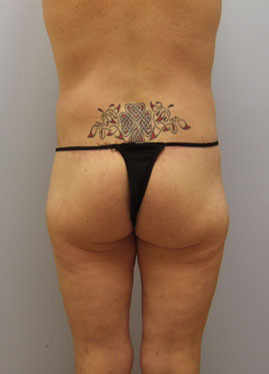 Thigh Lift Before & After Image