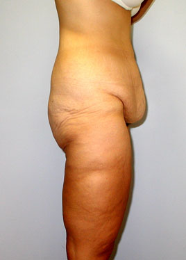 Thigh Lift Before & After Image