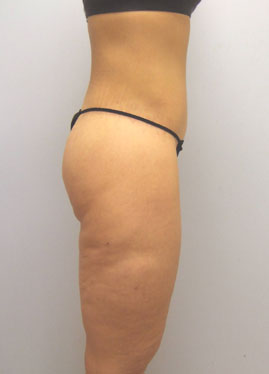 Thigh Lift Before & After Image