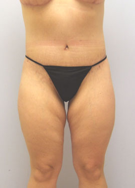 Thigh Lift Before & After Image