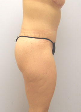 Thigh Lift Before & After Image