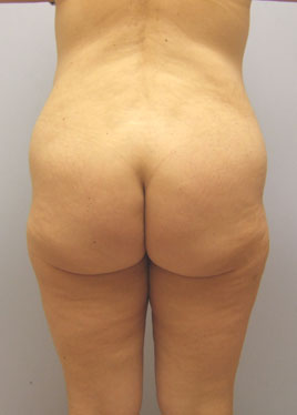 Thigh Lift Before & After Image