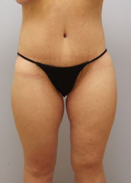 Thigh Lift Before & After Image