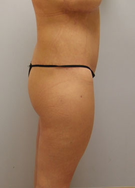 Thigh Lift Before & After Image