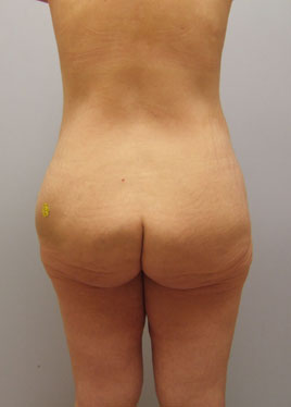 Thigh Lift Before & After Image