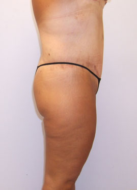 Thigh Lift Before & After Image