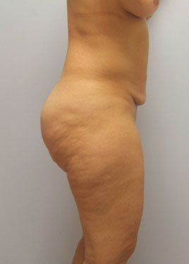 Thigh Lift Before & After Image