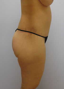 Thigh Lift Before & After Image