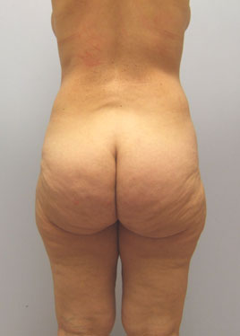 Thigh Lift Before & After Image