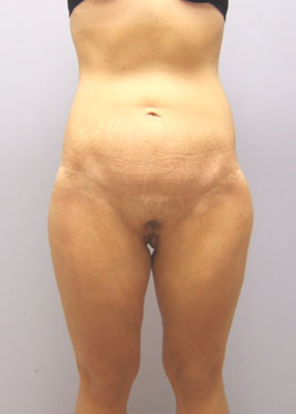 Thigh Lift Before & After Image