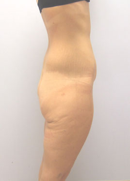 Thigh Lift Before & After Image