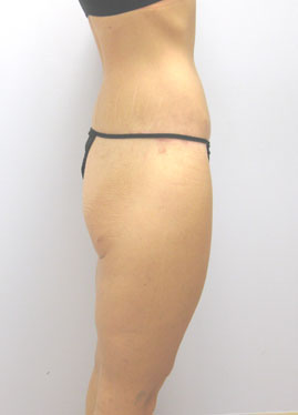 Thigh Lift Before & After Image