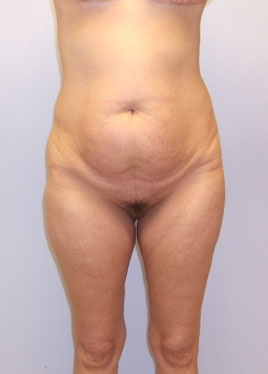 Thigh Lift Before & After Image