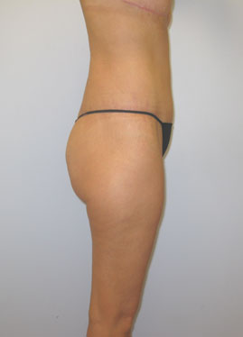 Thigh Lift Before & After Image