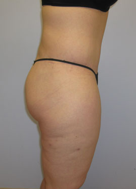 Thigh Lift Before & After Image