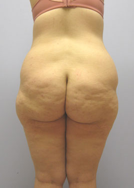 Thigh Lift Before & After Image