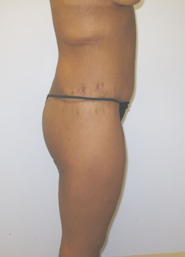 Thigh Lift Before & After Image