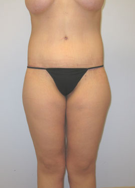 Thigh Lift Before & After Image