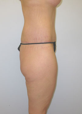 Thigh Lift Before & After Image