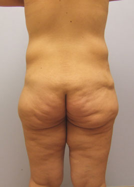 Thigh Lift Before & After Image