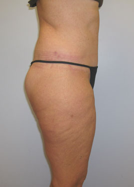 Thigh Lift Before & After Image