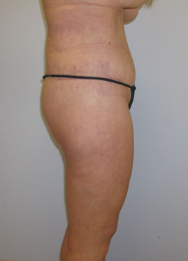 Thigh Lift Before & After Image