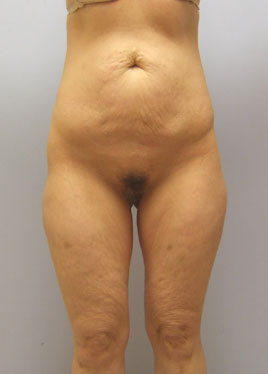 Thigh Lift Before & After Image