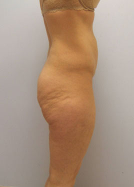 Thigh Lift Before & After Image