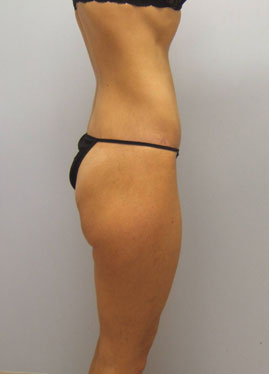 Thigh Lift Before & After Image