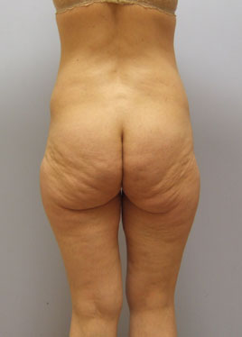 Thigh Lift Before & After Image