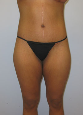 Thigh Lift Before & After Image