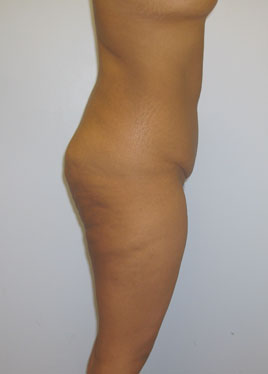 Thigh Lift Before & After Image