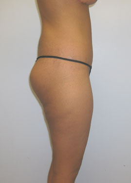 Thigh Lift Before & After Image