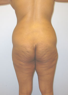 Thigh Lift Before & After Image