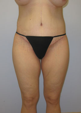 Thigh Lift Before & After Image