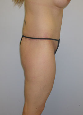 Thigh Lift Before & After Image