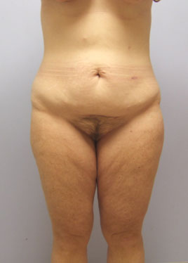 Thigh Lift Before & After Image