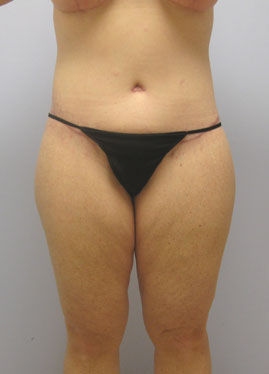 Thigh Lift Before & After Image