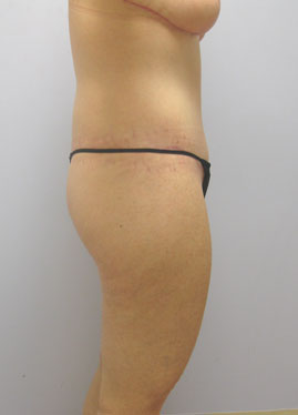 Thigh Lift Before & After Image