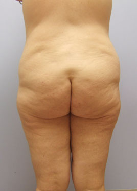 Thigh Lift Before & After Image