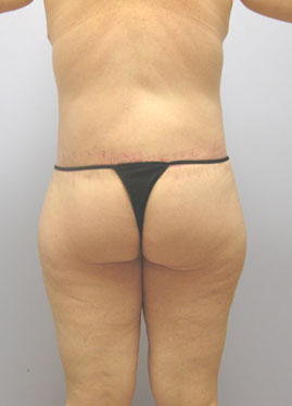 Thigh Lift Before & After Image